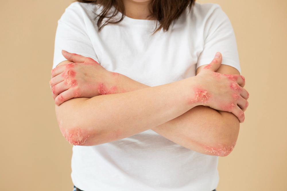 Hands of patient suffering from psoriasis